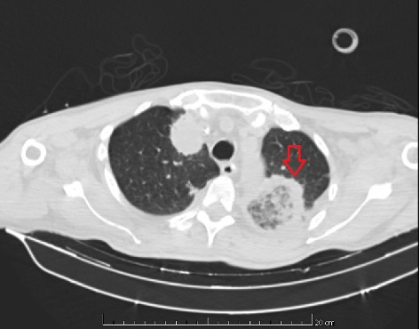 Mucormycosis Causing Splenic Infarction, Gastric Fistula, and Brain Abscess in a Patient With Acute Myeloid Leukemia: A Case Report.