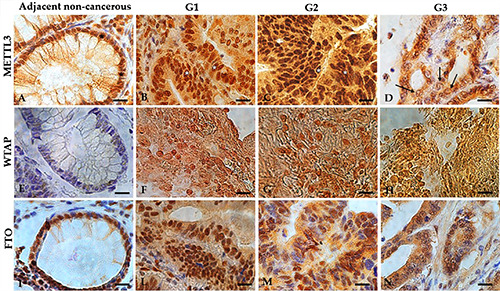 High WTAP expression level as a promising biomarker for poor prognosis in colorectal cancer: a pilot study.