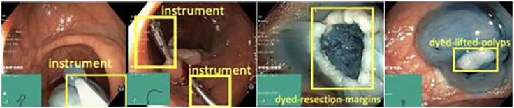 Application of artificial intelligence in gastrointestinal endoscopy in Vietnam: a narrative review.