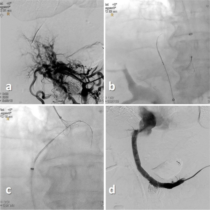 "Bottoms-up" portal venous recanalization TIPS (PVR-TIPS) utilizing a re-entry catheter.