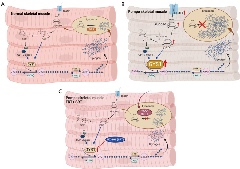 Expanding therapeutic options for Pompe disease: a new small molecule inhibitor of glycogen synthase 1 (GYS1) shows preclinical promise in Pompe disease.