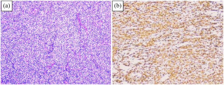 An Unusual Diagnosis of Rectosigmoid Leiomyoma in an Adult: A Rare Case Report.