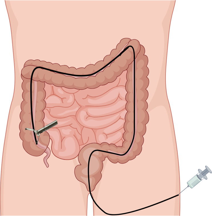 Washed microbiota transplantation stopped recurrent sepsis in a patient with myelofibrosis: a case report.