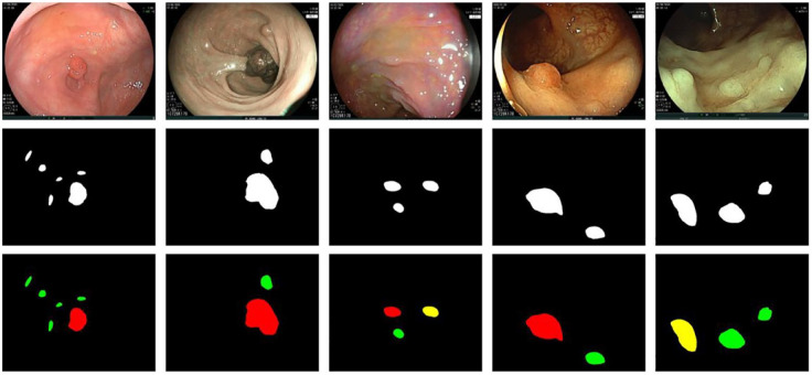 Application of artificial intelligence in gastrointestinal endoscopy in Vietnam: a narrative review.