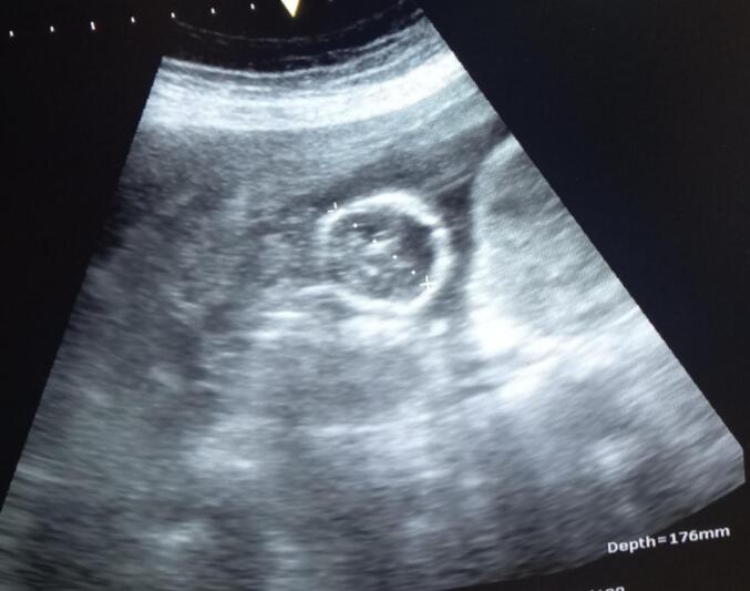 Second-trimester uterine rupture in bicornuate uterus: A case report
