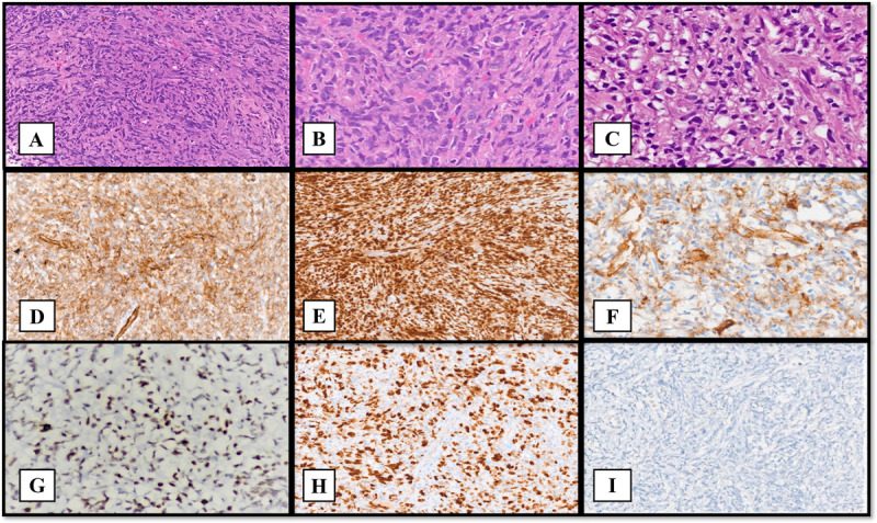 Primary Ovarian Angiosarcoma: Diagnostic Challenges and Conundrums.