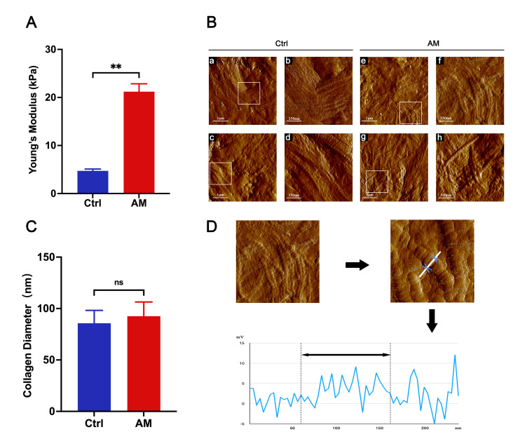 The matrix stiffness is increased in the eutopic endometrium of adenomyosis patients: a study based on atomic force microscopy and histochemistry.