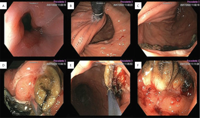 ENDOSCOPIC MANAGEMENT OF MESH MIGRATION FOLLOWING HIATAL HERNIA REPAIR.