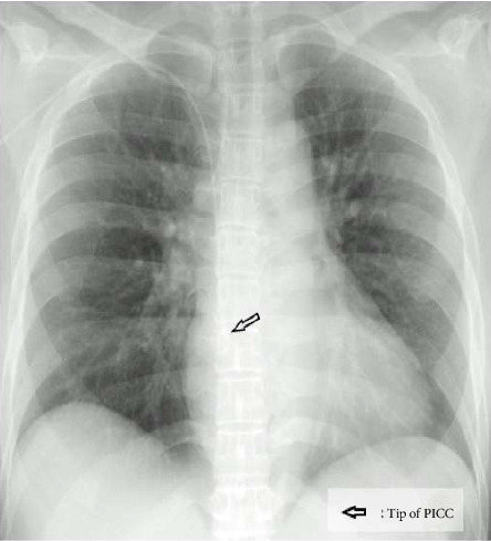 Arrhythmia Induced by Positional Change Under General Anesthesia Related to Caudal Movement of the Peripherally Inserted Central Venous Catheter: A Case Report.