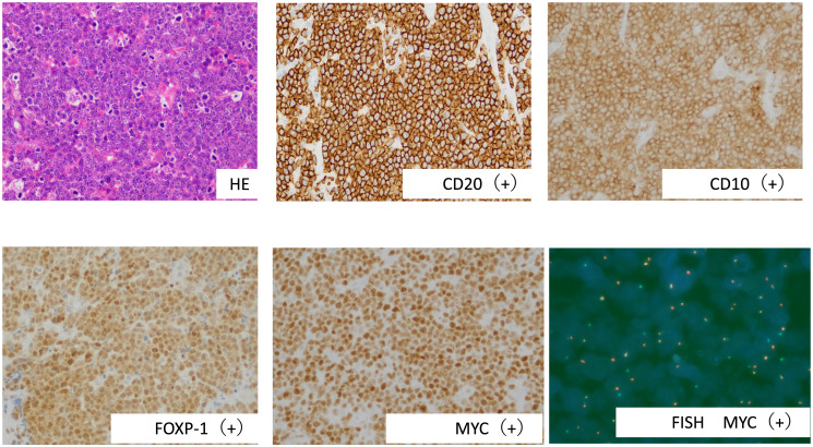 Clinicopathological and genetic analyses of thyroid large B-cell lymphoma in a Japanese population.