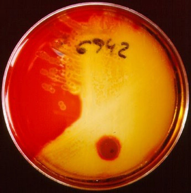 Invasive group A Streptococcus infection (Streptococcus pyogenes): Current situation in Spain.