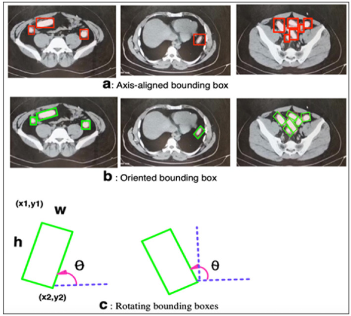 Detection of Body Packs in Abdominal CT scans Through Artificial Intelligence; Developing a Machine Learning-based Model.