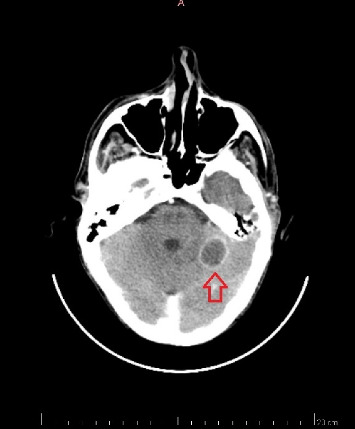 Mucormycosis Causing Splenic Infarction, Gastric Fistula, and Brain Abscess in a Patient With Acute Myeloid Leukemia: A Case Report.