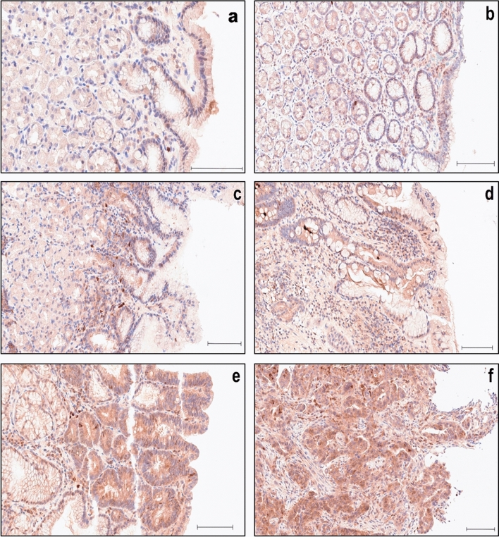 Differential expression of the ubiquitin-editing enzyme A20 in gastric biopsies indicates the severity of disease.
