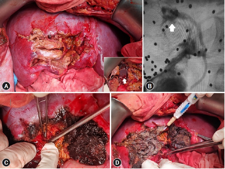 A starry night: a case report of severe liver injury due to a close-range shotgun blast in Argentina.
