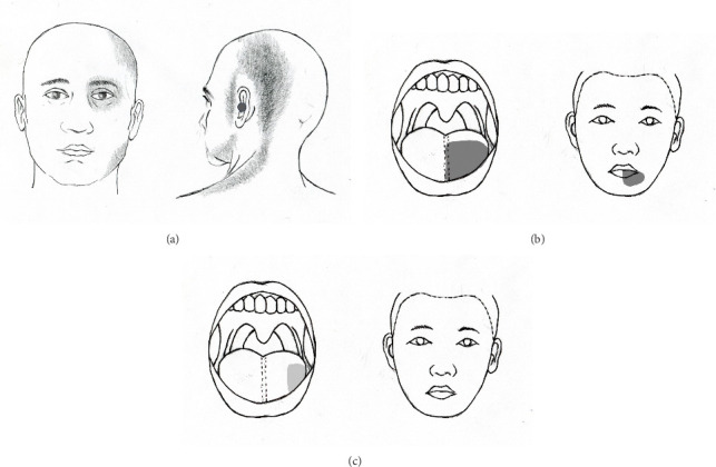 Involvement of the Ipsilateral Tongue, an Intraoral Structure of Referred Pain due to Entrapment of the Greater Occipital Nerve.