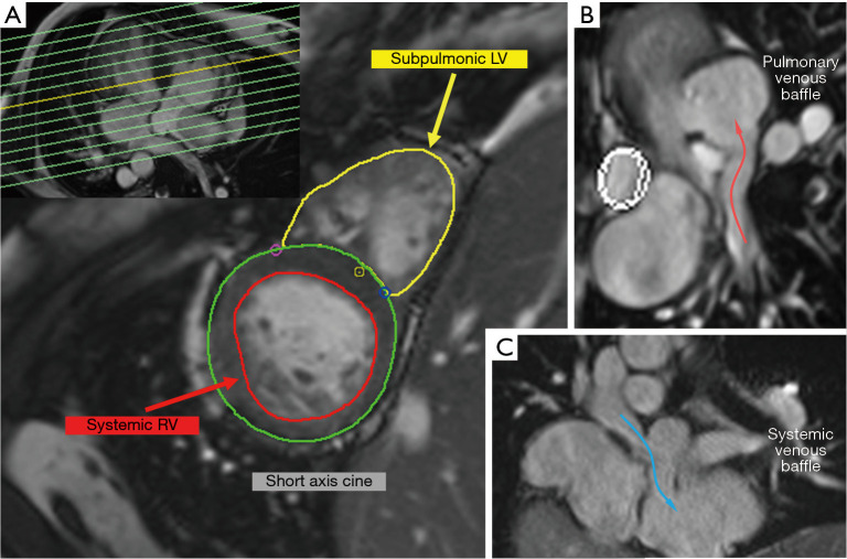Greater than the sum of its parts: multimodality imaging in adults with congenital heart disease.