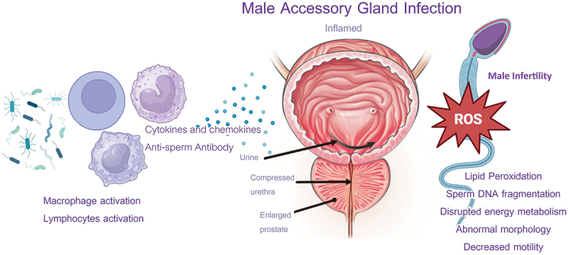 Male accessory gland infection (MAGI): Over-diagnosed or under treated in infertile men?