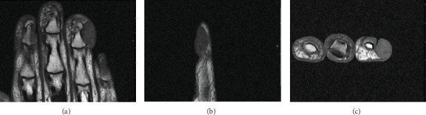 Digital Papillary Adenocarcinoma at the Site of 5 Years of Recurrent Paronychia: Case Report and Literature Review.