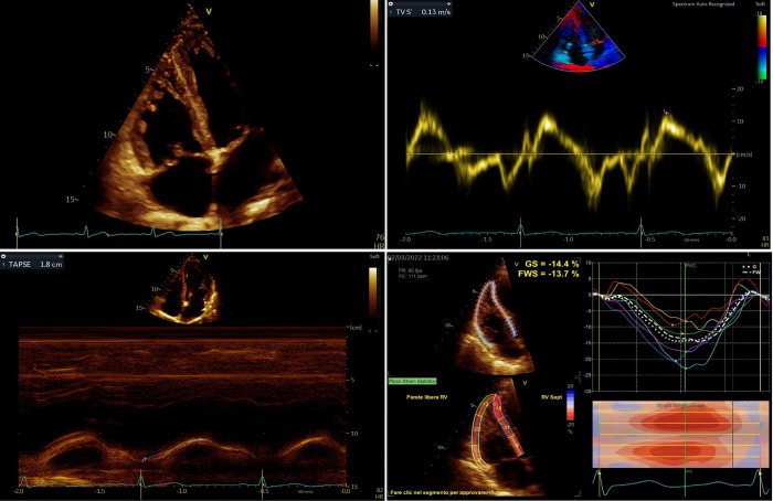 Right ventricle free wall longitudinal strain screening of lung transplant candidates.