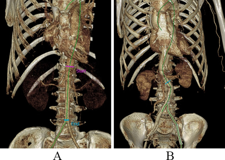 Anatomical analysis of the abdominal aorta in a South African sample: influence of age and sex.