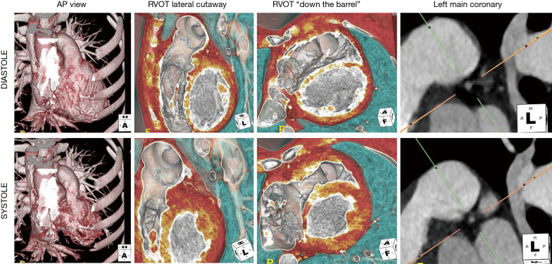 Greater than the sum of its parts: multimodality imaging in adults with congenital heart disease.