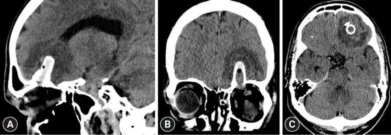 Endoscopic transorbital approach for the removal of a frontal lobe foreign body: a case report.