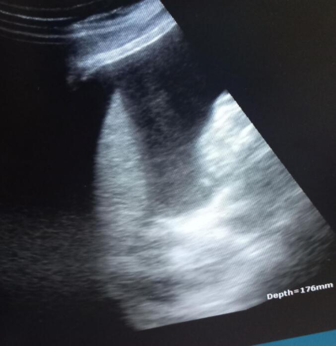 Second-trimester uterine rupture in bicornuate uterus: A case report