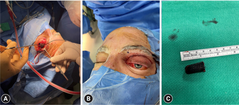 Endoscopic transorbital approach for the removal of a frontal lobe foreign body: a case report.