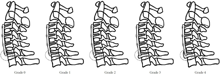 Radiographic Characteristics of Caudal Segment in Multilevel Anterior Cervical Discectomy and Fusion: The Bony Buttress Formation.
