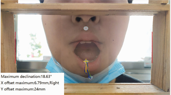 Dynamic automated assessment of functionally limited temporomandibular disorders using motion analysis.