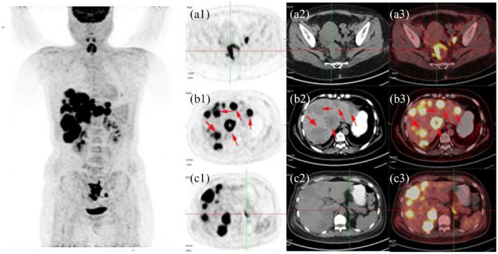 Ectopic corticotropin-releasing hormone syndrome caused by rectal large cell neuroendocrine carcinoma: a rare case report.