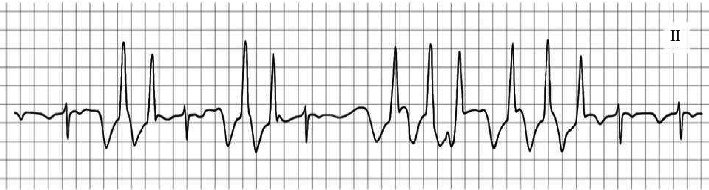 Arrhythmia Induced by Positional Change Under General Anesthesia Related to Caudal Movement of the Peripherally Inserted Central Venous Catheter: A Case Report.