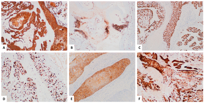 A Rare Case of a Malignant Proliferating Trichilemmal Tumor: A Molecular Study Harboring Potential Therapeutic Significance and a Review of Literature.