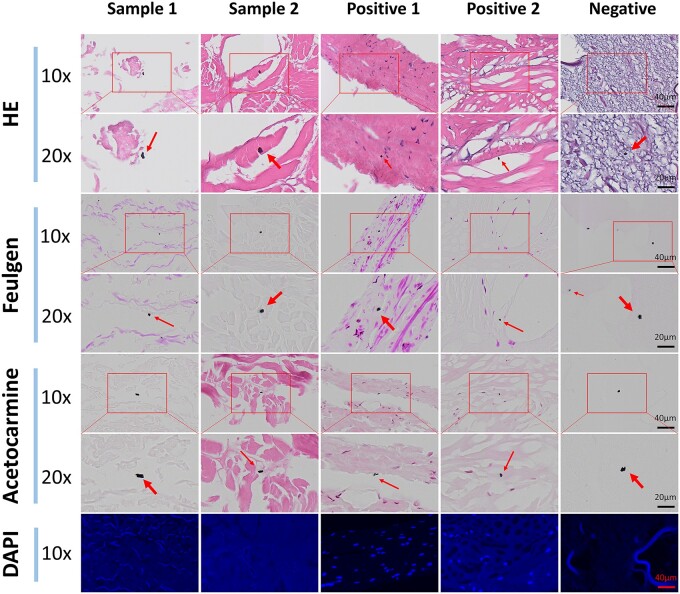 Semi-quantitative scoring criteria based on multiple staining methods combined with machine learning to evaluate residual nuclei in decellularized matrix.