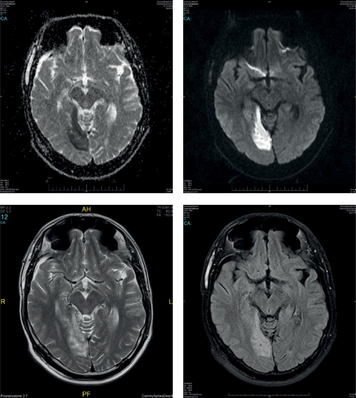 Migrainous stroke in a male patient with familial hemiplegic migraine.