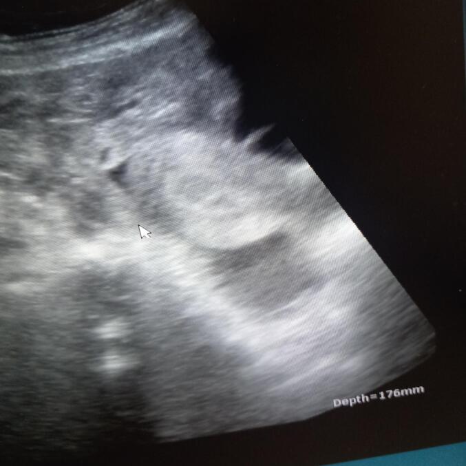 Second-trimester uterine rupture in bicornuate uterus: A case report