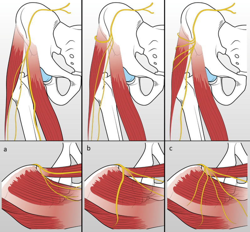 For many but not for all: the bikini incision direct anterior approach for total hip arthroplasty. A narrative review.