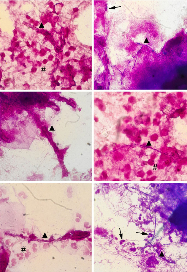 Subgingival biofilm colonization by Candida albicans and Candida dubliniensis in patients living with HIV from Buenos Aires, Argentina.