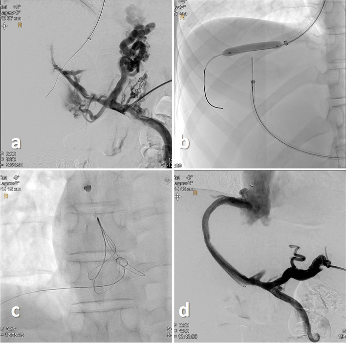 "Bottoms-up" portal venous recanalization TIPS (PVR-TIPS) utilizing a re-entry catheter.