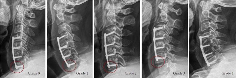 Radiographic Characteristics of Caudal Segment in Multilevel Anterior Cervical Discectomy and Fusion: The Bony Buttress Formation.