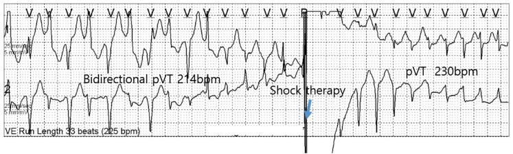 Treatment Outcomes in Children With Catecholaminergic Polymorphic Ventricular Tachycardia: A Single Institutional Experience.