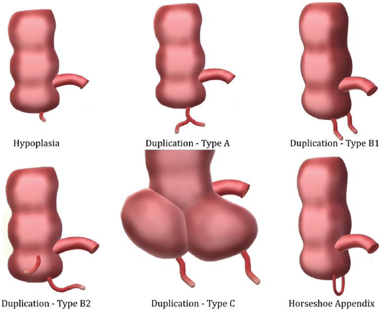 Anatomical Variations of the Vermiform Appendix.