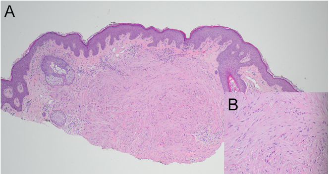 Hereditary leiomyomatosis and renal cell cancer (HLRCC), pheochromocytoma (PCC)/paraganglioma (PGL) and germline fumarate hydratase (FH) variants.