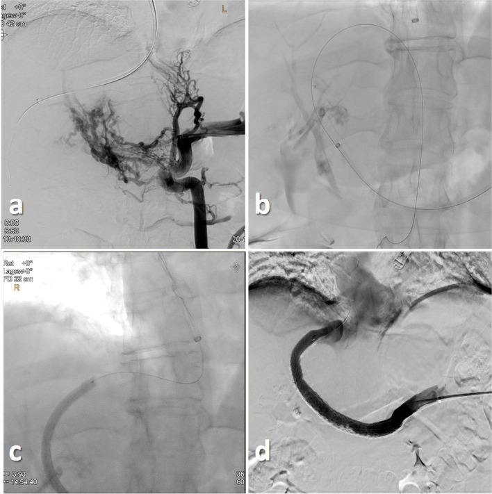 "Bottoms-up" portal venous recanalization TIPS (PVR-TIPS) utilizing a re-entry catheter.