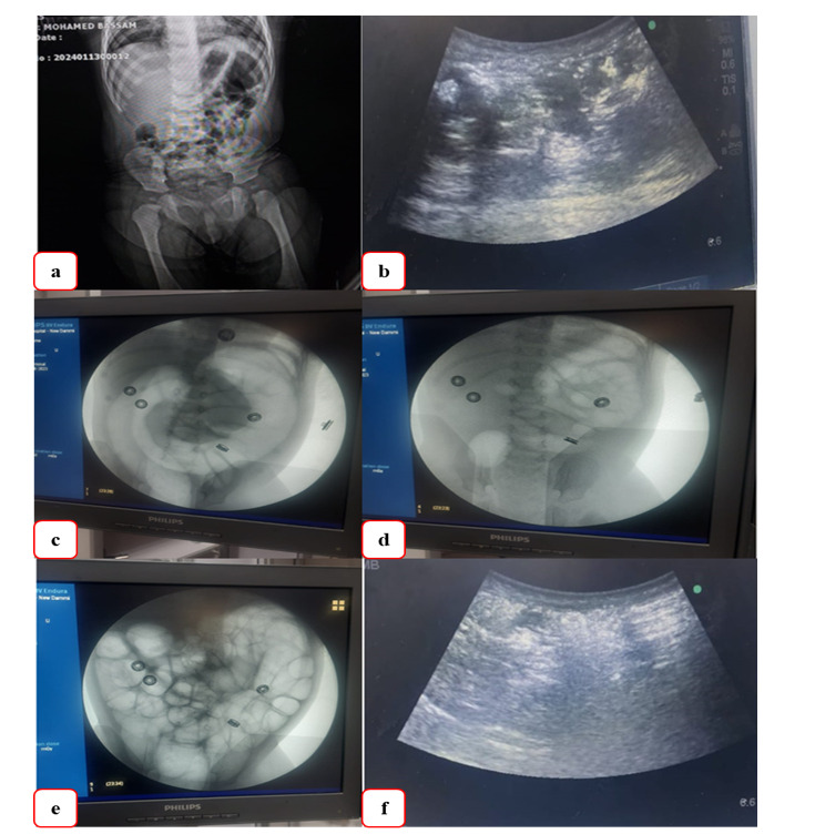 Effects of General Anesthesia on the Success Rate of Pneumatic Reduction in the Treatment of Intussusception.
