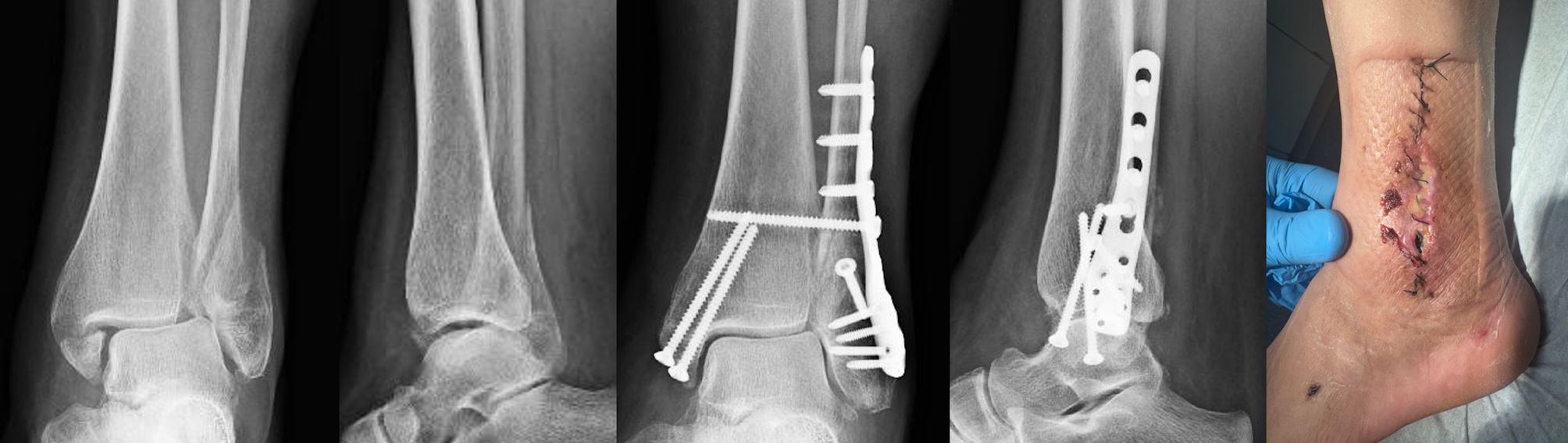 Modern anatomical locking plates are associated with increased postoperative wound complications and unplanned surgical revisions compared to standard tubular plates in the management of unstable ankle fractures: a comparative cohort study in 595 patients.