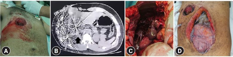 A starry night: a case report of severe liver injury due to a close-range shotgun blast in Argentina.