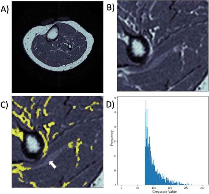 Fully-automated segmentation of muscle and inter-/intra-muscular fat from magnetic resonance images of calves and thighs: an open-source workflow in Python.