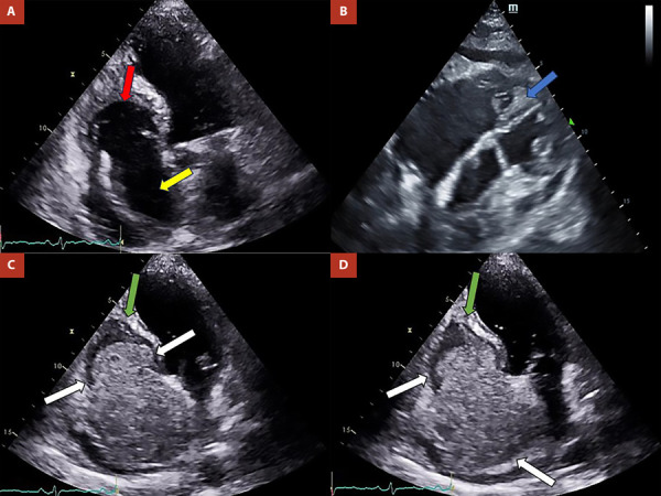 [Right ventricular endomyocardial fibrosis: Atypical presentation of a rare disease. Case report].